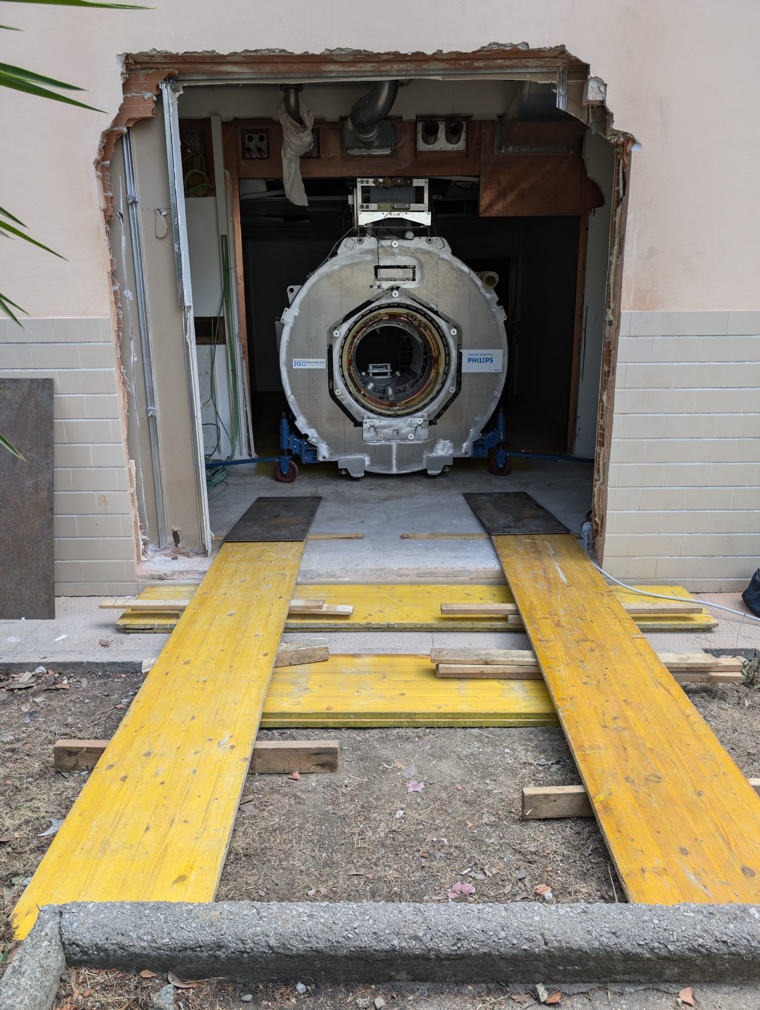 rimozione magnete Ospedale San Paolo